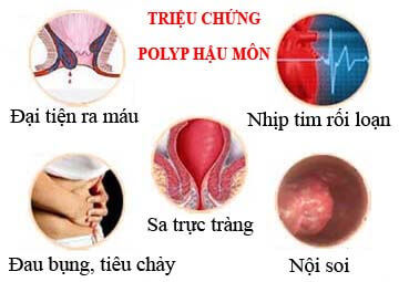 Triệu chứng bệnh polyp hậu môn Triệu chứng bệnh polyp hậu môn