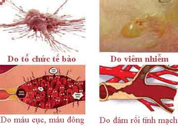 triệu chứng bệnh trĩ ngoại triệu chứng bệnh trĩ ngoại