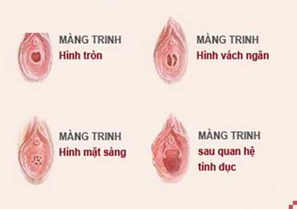 Vá màng trinh ở đâu an toàn Vá màng trinh ở đâu an toàn