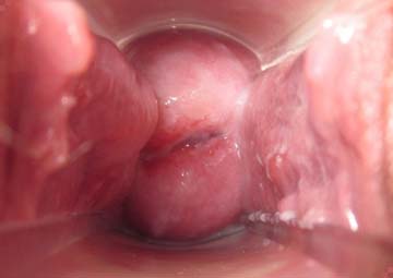 Hình ảnh viêm lộ tuyến cổ tử cung Hình ảnh viêm lộ tuyến cổ tử cung