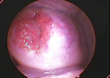 Hình ảnh viêm lộ tuyến cổ tử cung Hình ảnh viêm lộ tuyến cổ tử cung