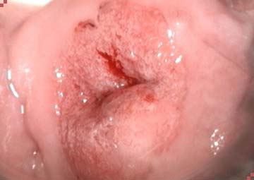 Hình ảnh viêm lộ tuyến cổ tử cung