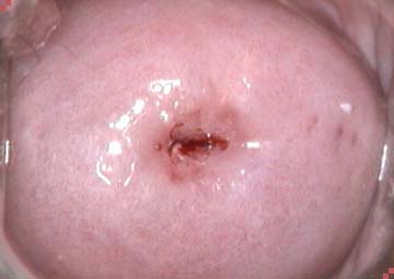 Hình ảnh viêm lộ tuyến cổ tử cung