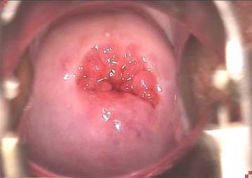 Hình ảnh viêm lộ tuyến cổ tử cung Hình ảnh viêm lộ tuyến cổ tử cung