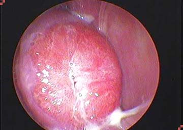 Hình ảnh viêm lộ tuyến cổ tử cung Hình ảnh viêm lộ tuyến cổ tử cung