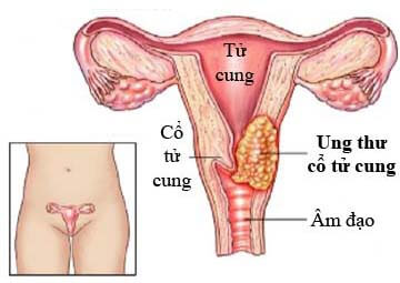 Ung thư cổ tử cung – Bệnh ung thư đường sinh dục Ung thư cổ tử cung