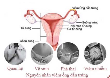 Nguyên nhân gây viêm ống dẫn trứng