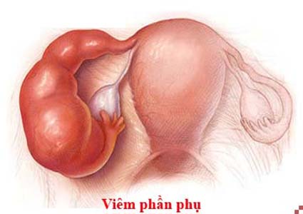 Viêm phần phụ Viêm phần phụ