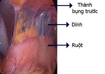 Hình Ảnh Viêm Vùng Chậu: Nguyên Nhân và Cách Điều Trị