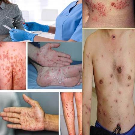15 địa chỉ khám chữa bệnh giang mai ở đâu tốt nhất tại Hà Nội 15 địa chỉ khám chữa bệnh giang mai ở đâu tốt nhất tại Hà Nội